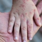 Pemerintah Imbau Masyarakat Hindari Menyentuh Bayi dan Balita Saat Lebaran untuk Cegah Penularan Campak